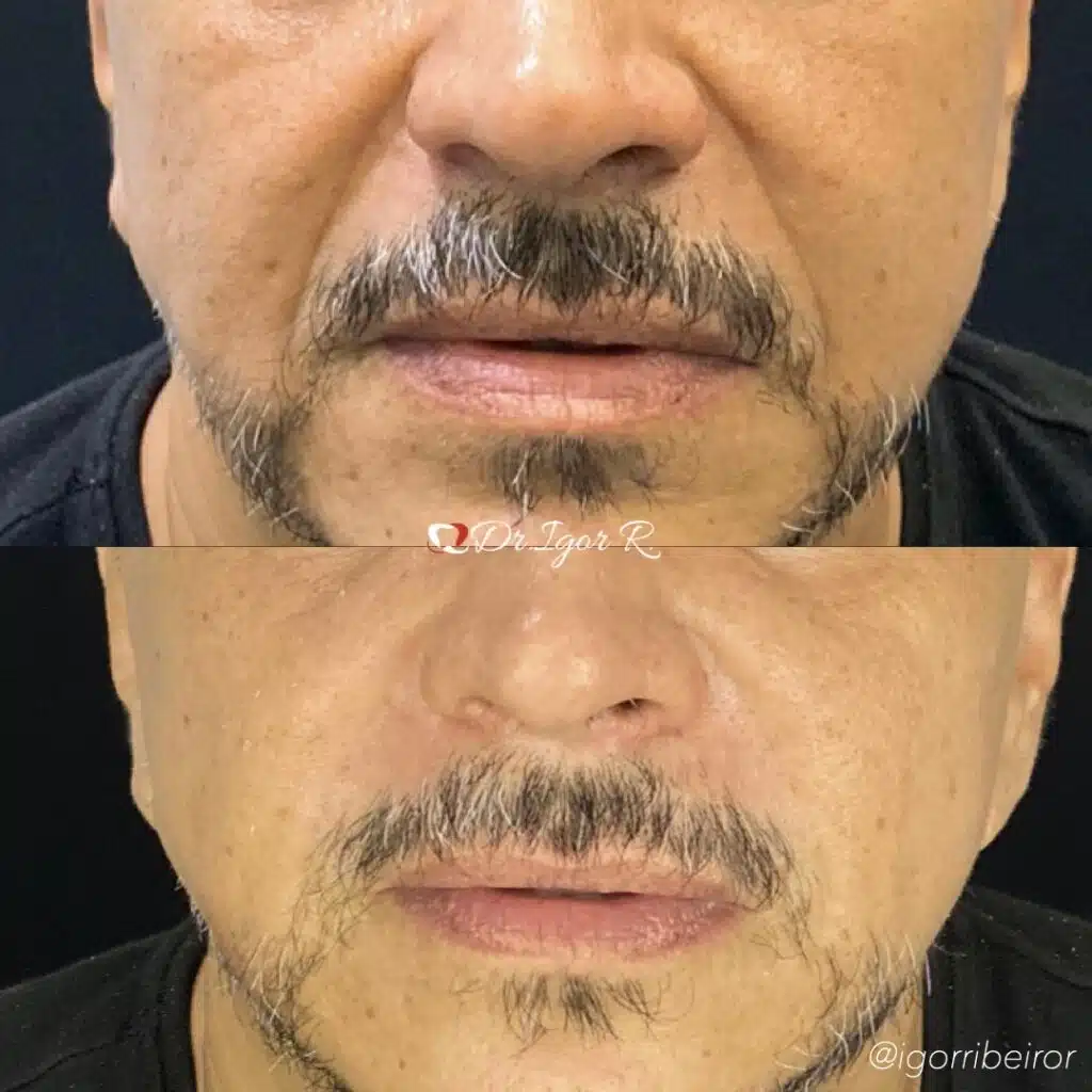 Descubra Como o MD Codes em Fortaleza Pode Transformar o Seu Rosto 3 Antes e Depois insta.051