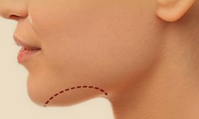 La diferencia entre Enzymatic Double Lip Lipo en Fortaleza Liposucción Quirúrgica 2 Liposucción de papada - grasa submentoniana