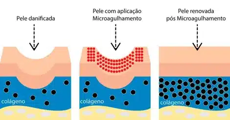 Microagulhamento: um tratamento eficaz para a sua pele | Clínica de Estética em Fortaleza 2 Microagulhamento em Fortaleza