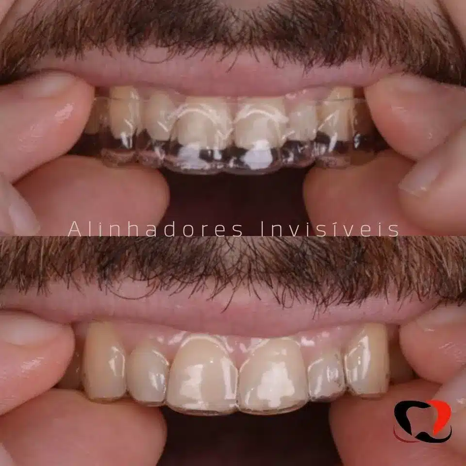 As 10 perguntas que todo mundo faz sobre Aparelho Ortodôntico em Fortaleza 3 Invisalign em Fortaleza