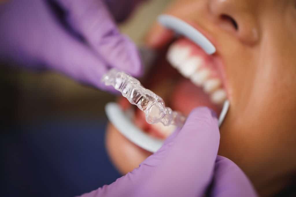 Find the best invisible aligners in Fortaleza 2 invisalign braces 2022 06 22 15 27 39 utc Large