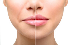Mouth Filler: Advanced Techniques for Your Beauty 2 Lip filling in Fortaleza aesthetic clinic in Fortaleza