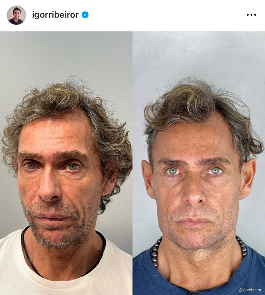 Filler completo del viso con botox e sculptra della mascella