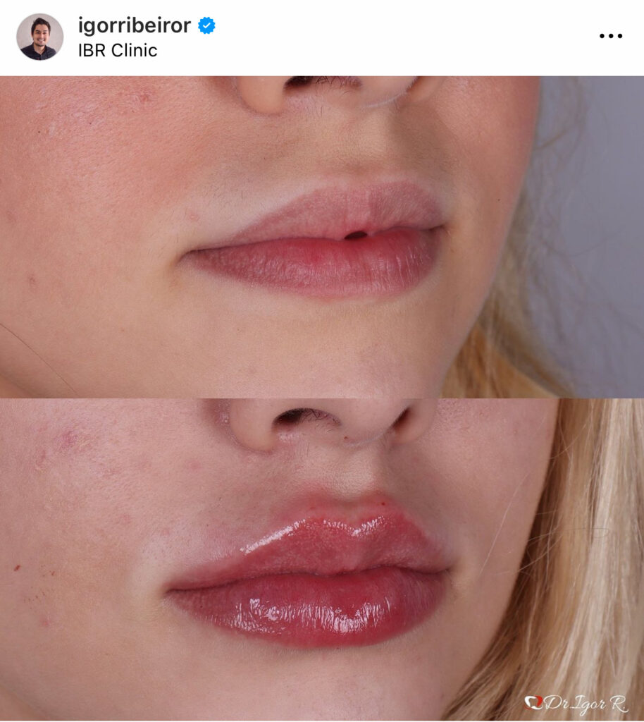 Preenchimento Labial em Fortaleza Harmonizacao Facial clinica de estetica em fortaleza dr igor ribeiro
