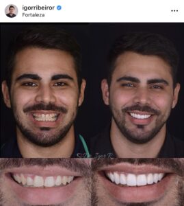 Lentes Dentais 2026 em Fortaleza: A Nova Era da Estética Dental Integrada 2 Lente Dental em Fortaleza aparelho ortodôntico