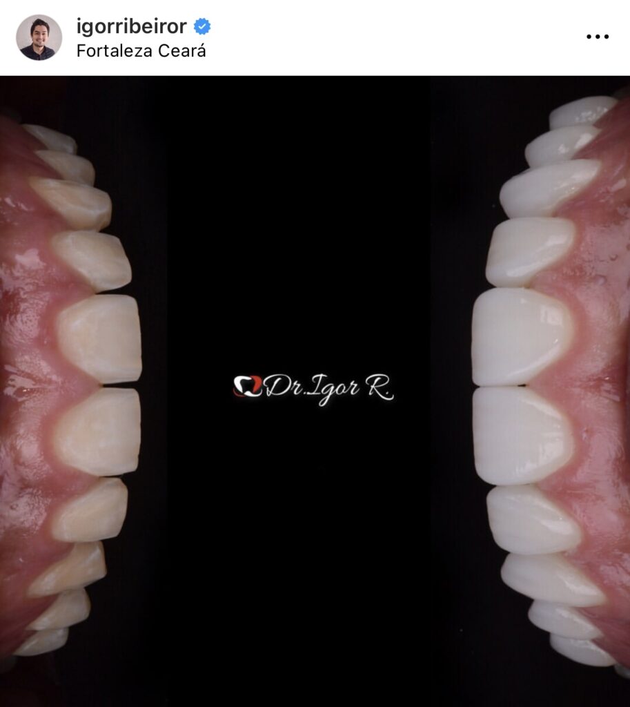 Transformación de Sonrisa con 10 Lentes de Contacto Dentales - Jugador Felipe Jonatan - Fortaleza 3 Lente dental Carillas de porcelana Felipe Jr Jugador Fortaleza Santos Odontólogo Dr. Igor Ribeiro