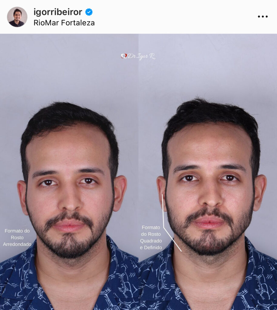 Conheça o Preenchimento Mandibular, procedimento que melhora o Contorno, Definição e ângulo da mandíbula 4 Preenchimento mandibular em fortaleza clinica estética mandibula