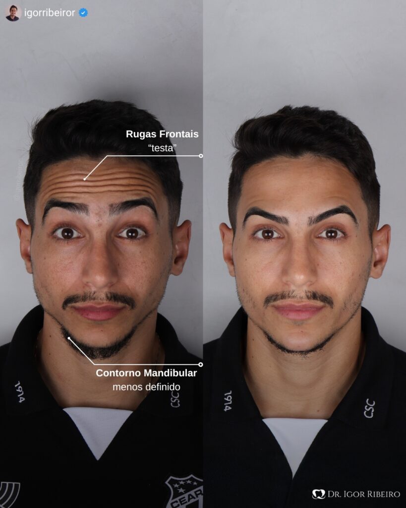 botox fortaleza rugas na testa e mandibula Dr. Igor Ribeiro Rola CRO 9062-CE