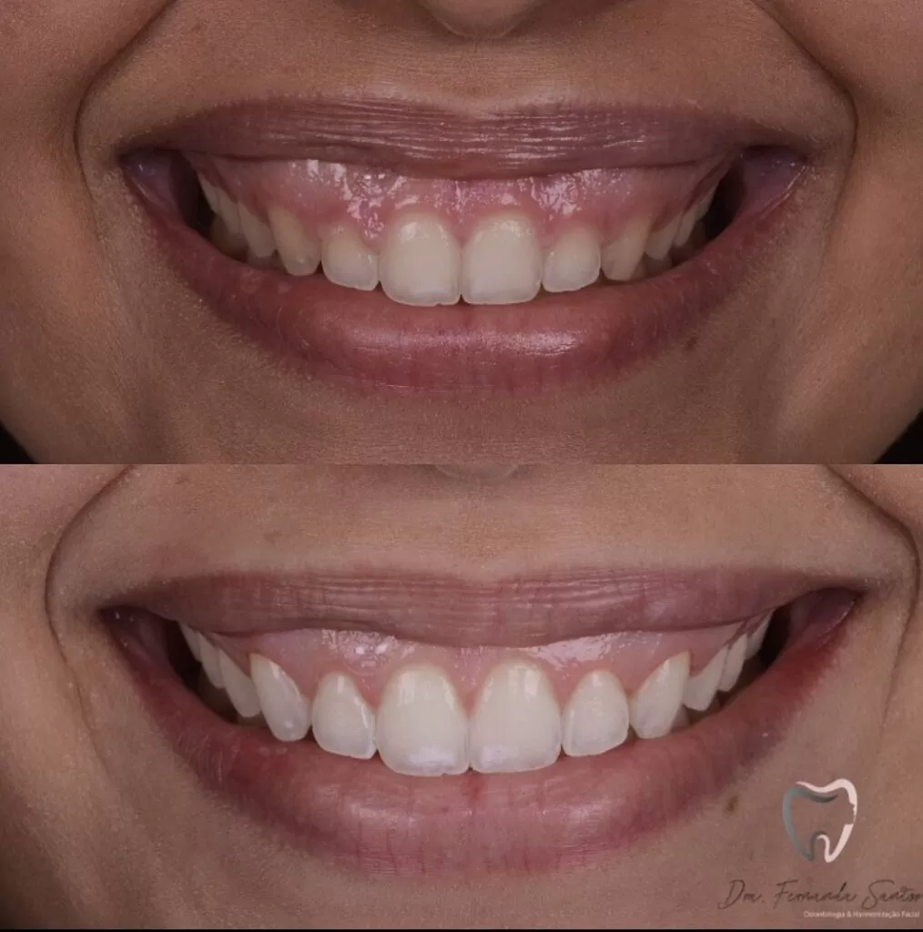 Gingivoplastia en Fortaleza