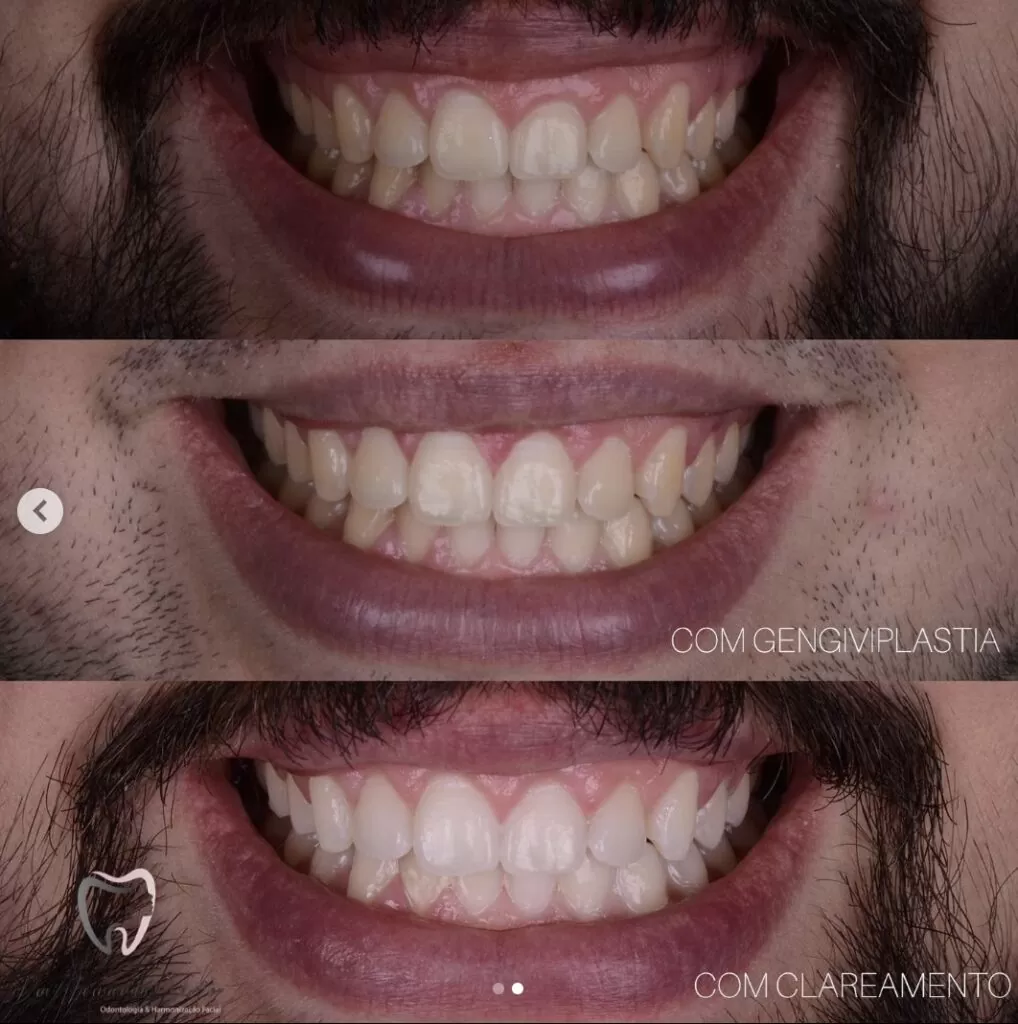 Gingivoplastia en Fortaleza