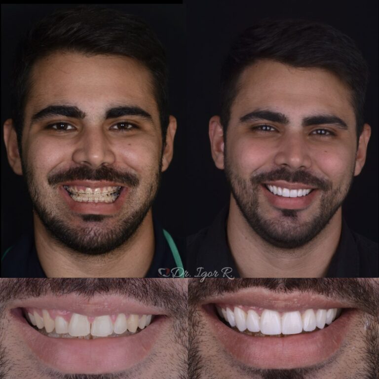 Antes e Depois Lente de contato dental em Fortaleza Dr. Igor Ribeiro | Igor Ribeiro
