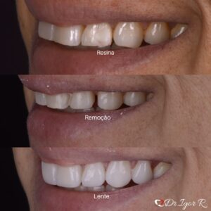 Read more about the article Tratamento Dentário com Porcelana em Fortaleza: Guia Completo