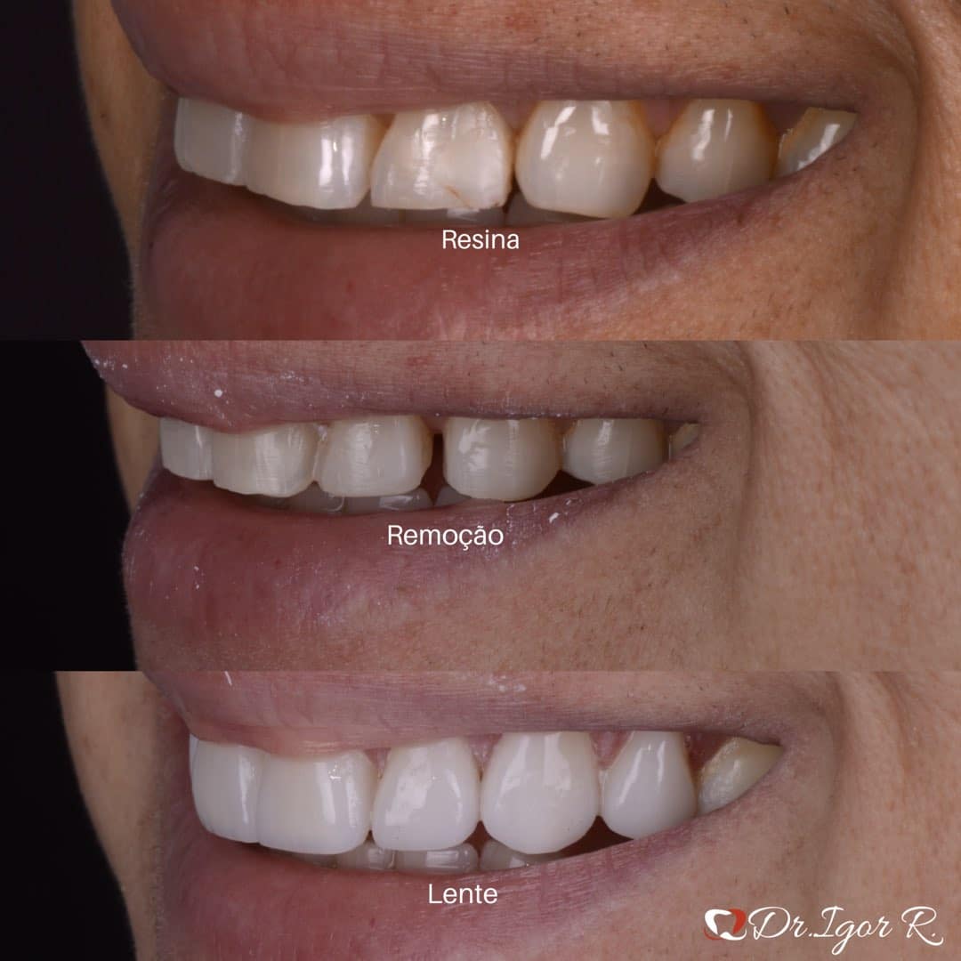 Scopri di più sull'articolo Tratamento Dentário com Porcelana em Fortaleza: Guia Completo