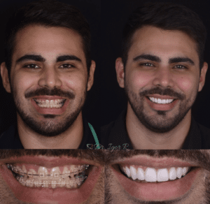 Dental Contact Lens in Fortaleza Dr. Igor Ribeiro Facial Harmonization