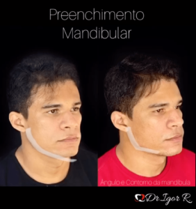 Read more about the article Conheça o Preenchimento Mandibular, procedimento que melhora o Contorno, Definição e ângulo da mandíbula