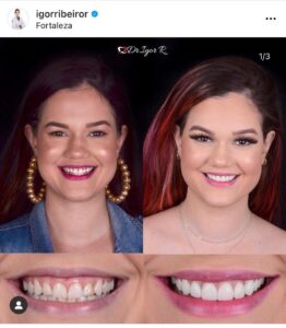 Home 5 Antes e depois de lentes dentais IPS e.max — correção de Resinas antigas pelo Dr. Igor Ribeiro, Fortaleza-CE