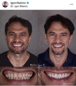 Home 9 Antes e depois de lentes dentais IPS e.max — correção de Bruxismo pelo Dr. Igor Ribeiro, Fortaleza-CE