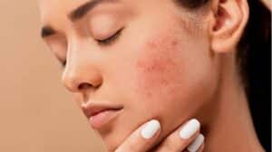 Leer más sobre el artículo 7 FORMAS DE ELIMINAR CICATRIZES DE ACNE EM FORTALEZA