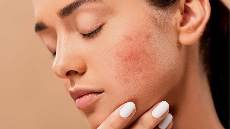 Leia mais sobre o artigo 7 FORMAS DE ELIMINAR CICATRIZES DE ACNE EM FORTALEZA