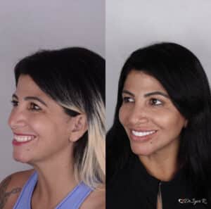Home 7 Antes e depois de Harmionização facial — correção de Rugas e marcas de expressao com uso de preenchimento full face pelo Dr. Igor Ribeiro, Fortaleza-CE