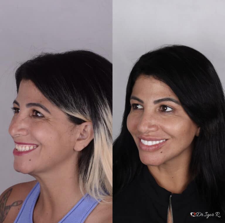 Home 24 Antes e depois de Harmionização facial — correção de Rugas e marcas de expressao com uso de preenchimento full face pelo Dr. Igor Ribeiro, Fortaleza-CE