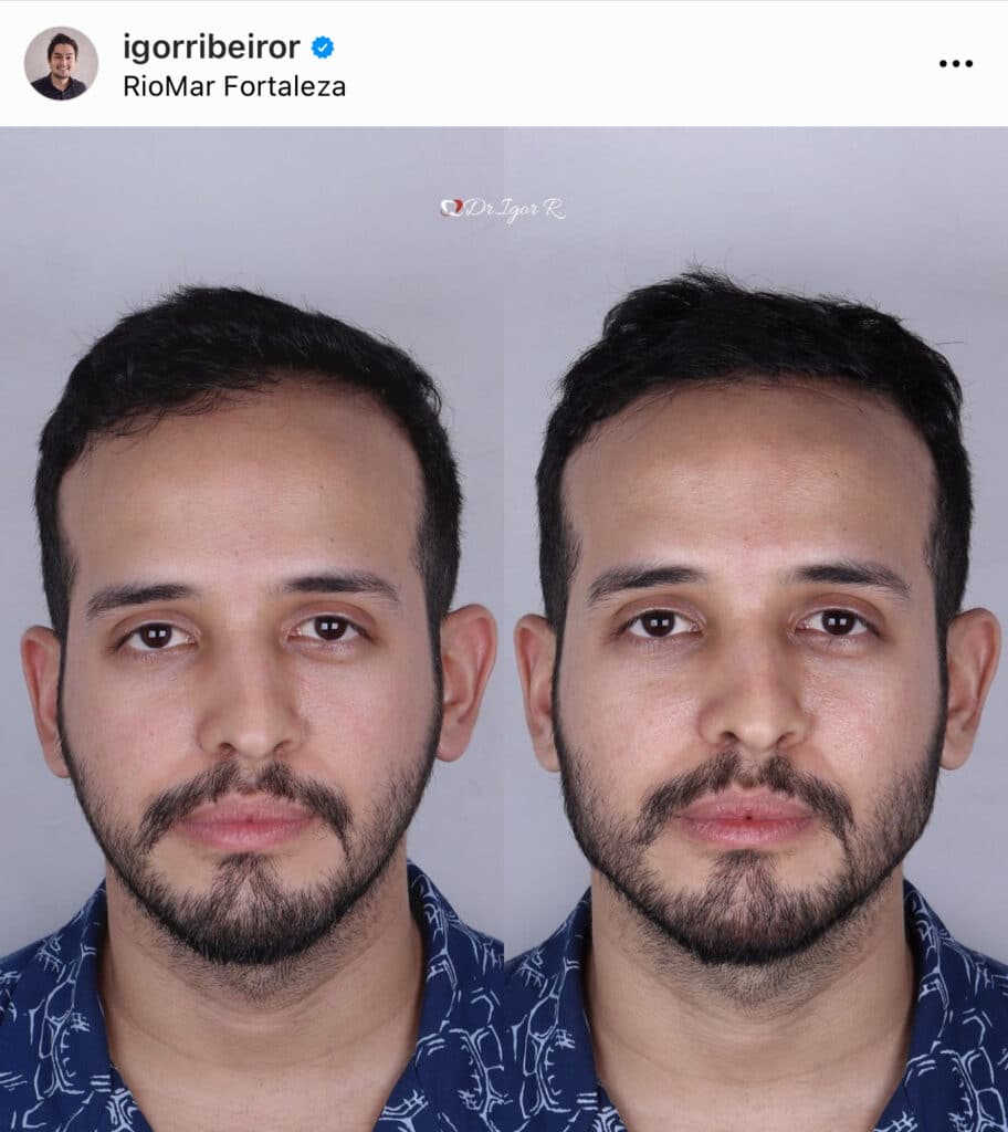 Dr. Igor Ribeiro — Dentist CRO-CE 9062 IBR Clinic Fortaleza