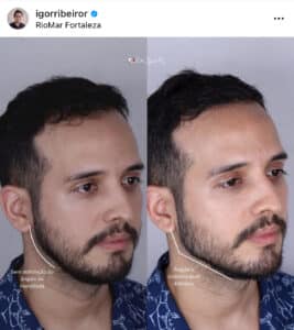 Home 4 Preenchimento Mandíbula em Fortaleza