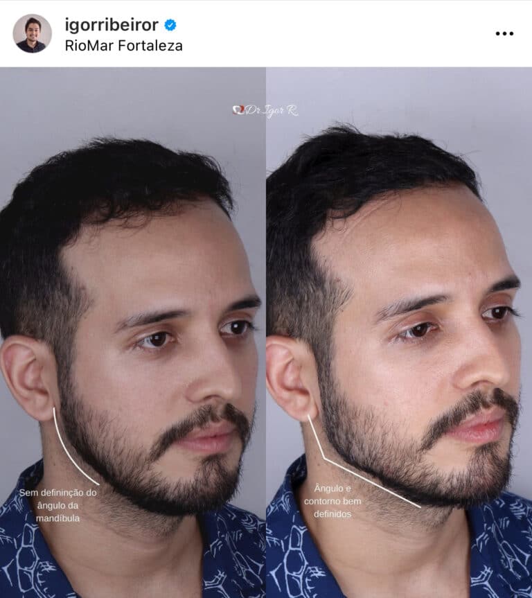 Injections de comblement de la mâchoire à Fortaleza