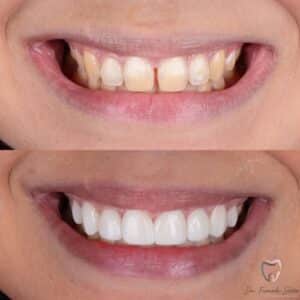 Leer más sobre el artículo Facetas em resina ou lentes em resina: o que todo mundo quer saber