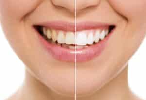 Clareamento dentário em Fortaleza