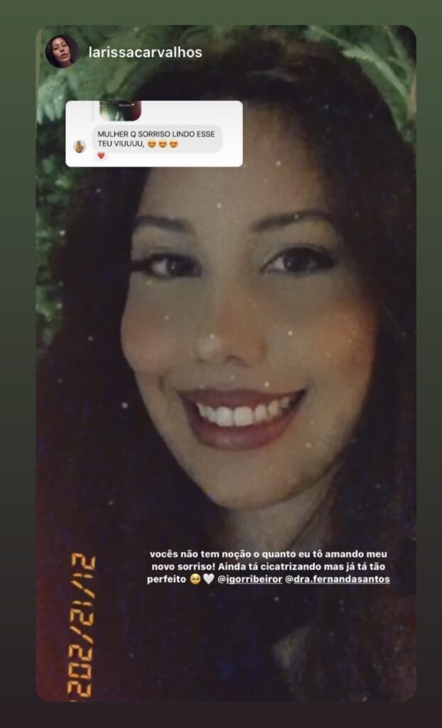 Facetas em Resina 17 Dr Igor Ribeiro — Dentiste CRO-CE 9062 Clinique IBR Fortaleza