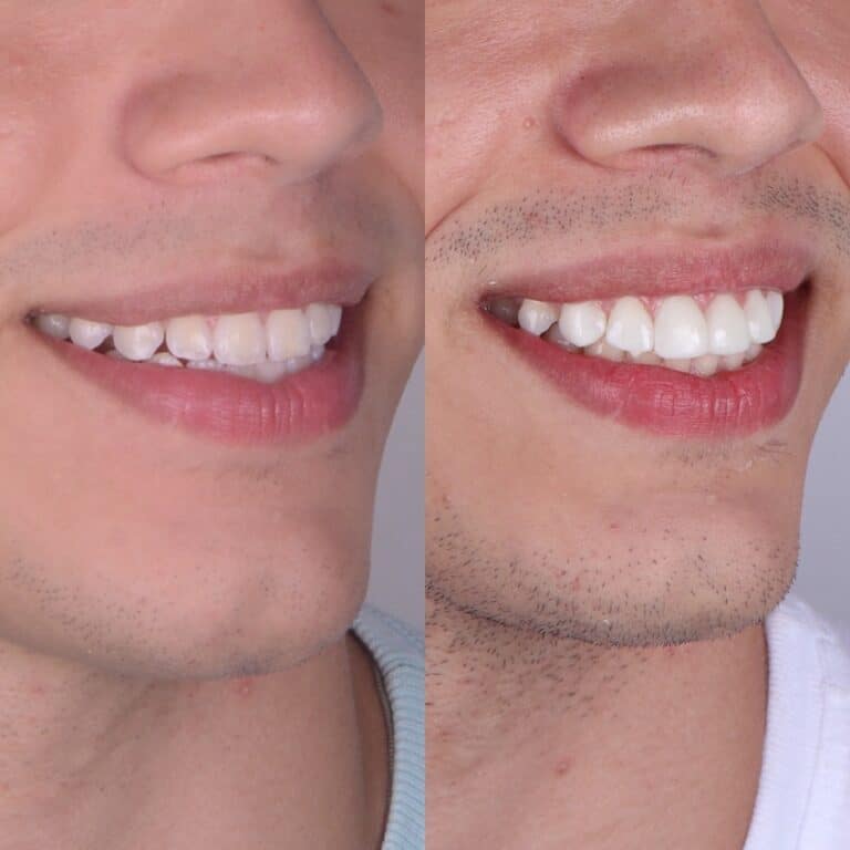 Facetas em Resina 24 Dr Igor Ribeiro — Dentiste CRO-CE 9062 Clinique IBR Fortaleza