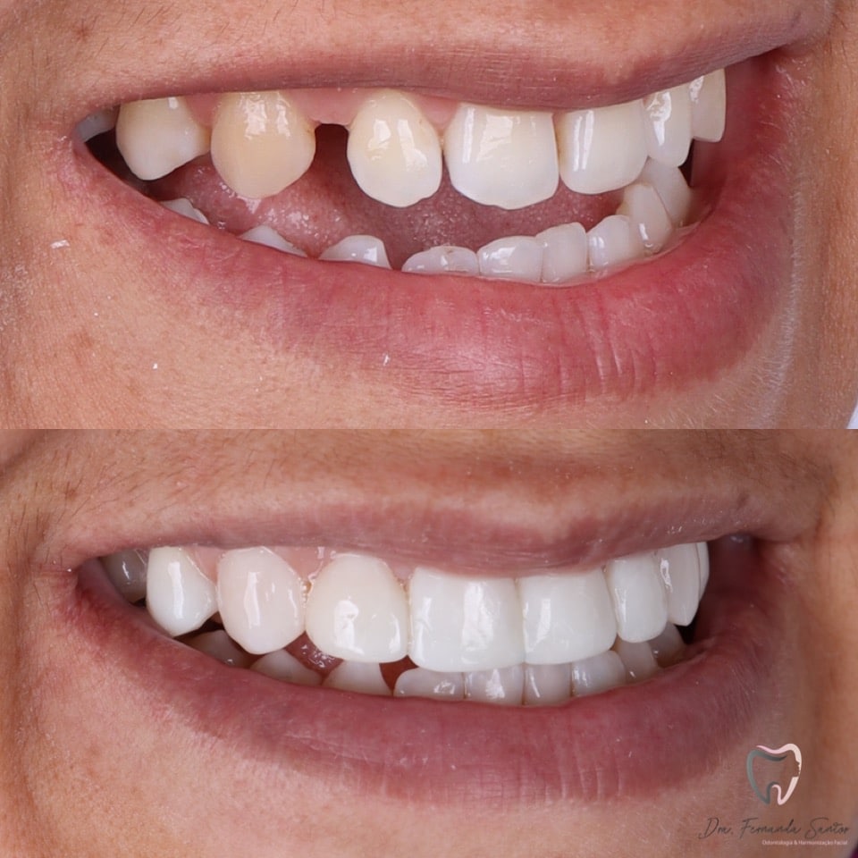 Facetas em Resina 23 Dr Igor Ribeiro — Dentiste CRO-CE 9062 Clinique IBR Fortaleza