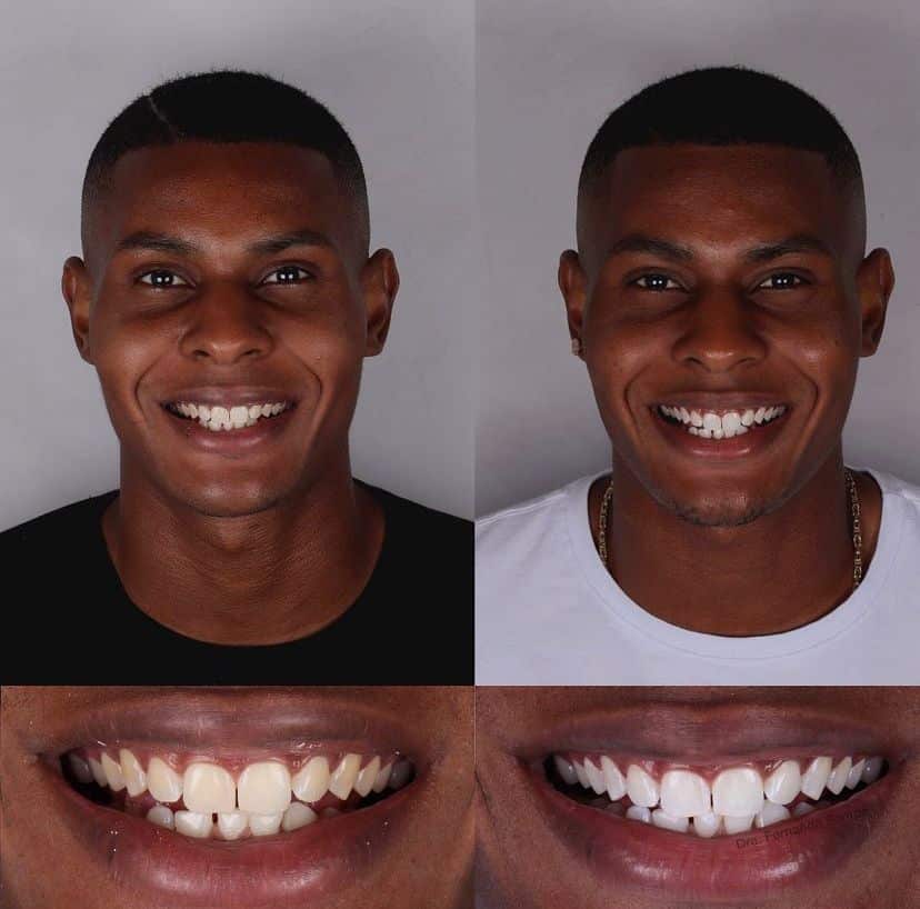 Facetas em Resina 28 Dr Igor Ribeiro — Dentiste CRO-CE 9062 Clinique IBR Fortaleza