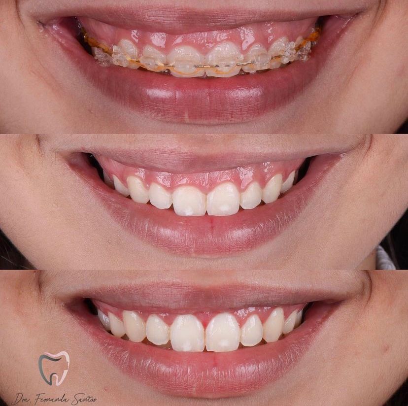 Facetas em Resina 27 Dr Igor Ribeiro — Dentiste CRO-CE 9062 Clinique IBR Fortaleza
