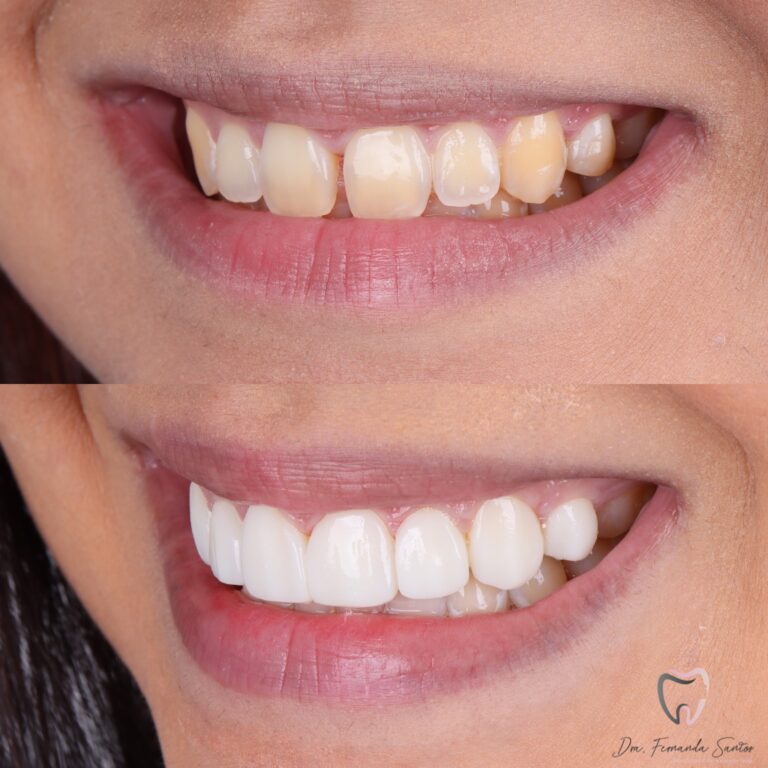 Facetas em Resina 19 Dr Igor Ribeiro — Dentiste CRO-CE 9062 Clinique IBR Fortaleza