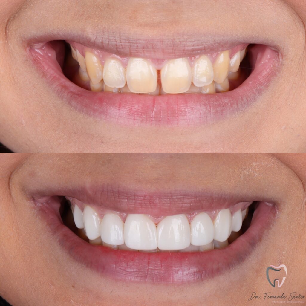 Facetas em Resina 21 Dr Igor Ribeiro — Dentiste CRO-CE 9062 Clinique IBR Fortaleza
