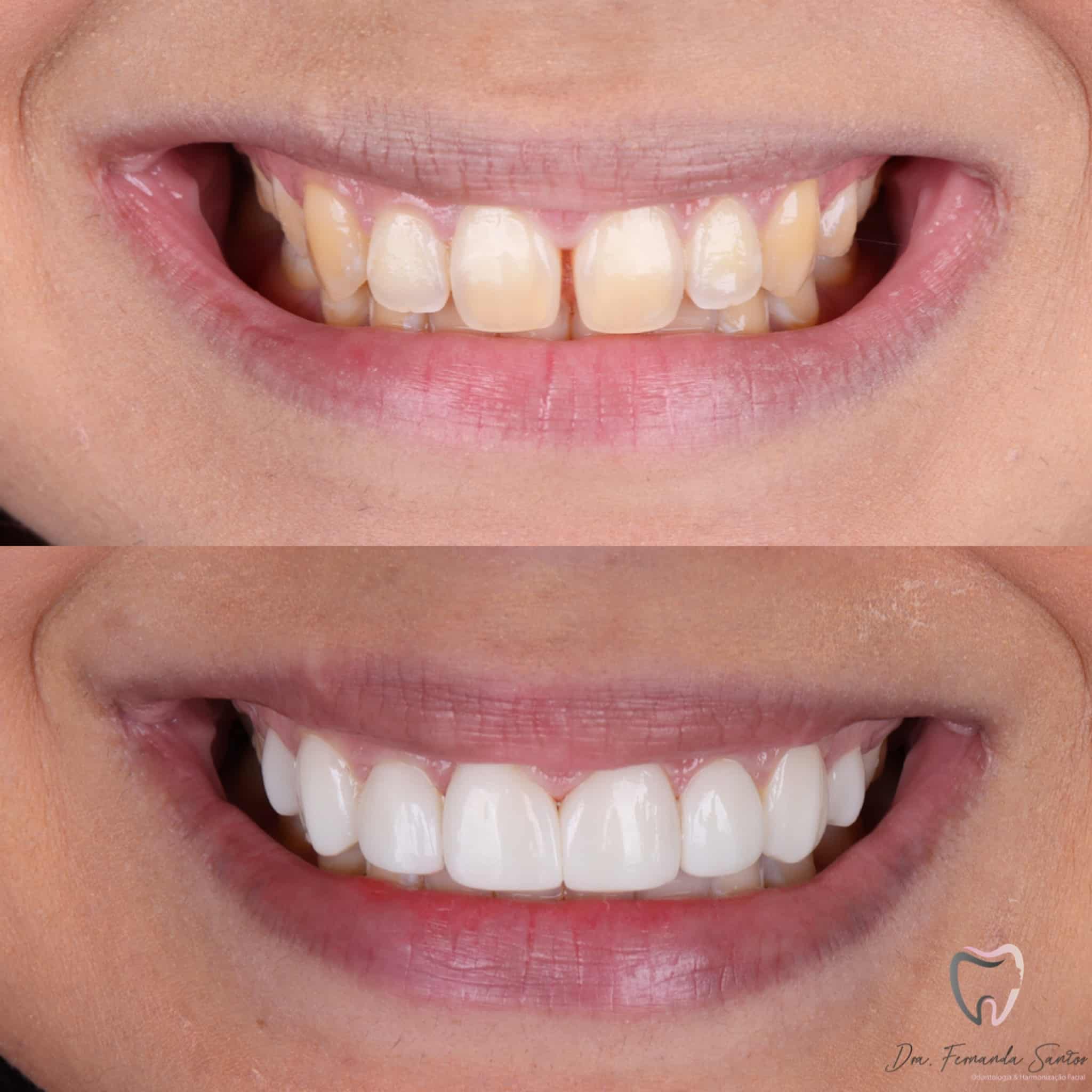 Read more about the article Facetas de Resina em Fortaleza: Fotos [Antes/Depois] e Durabilidade