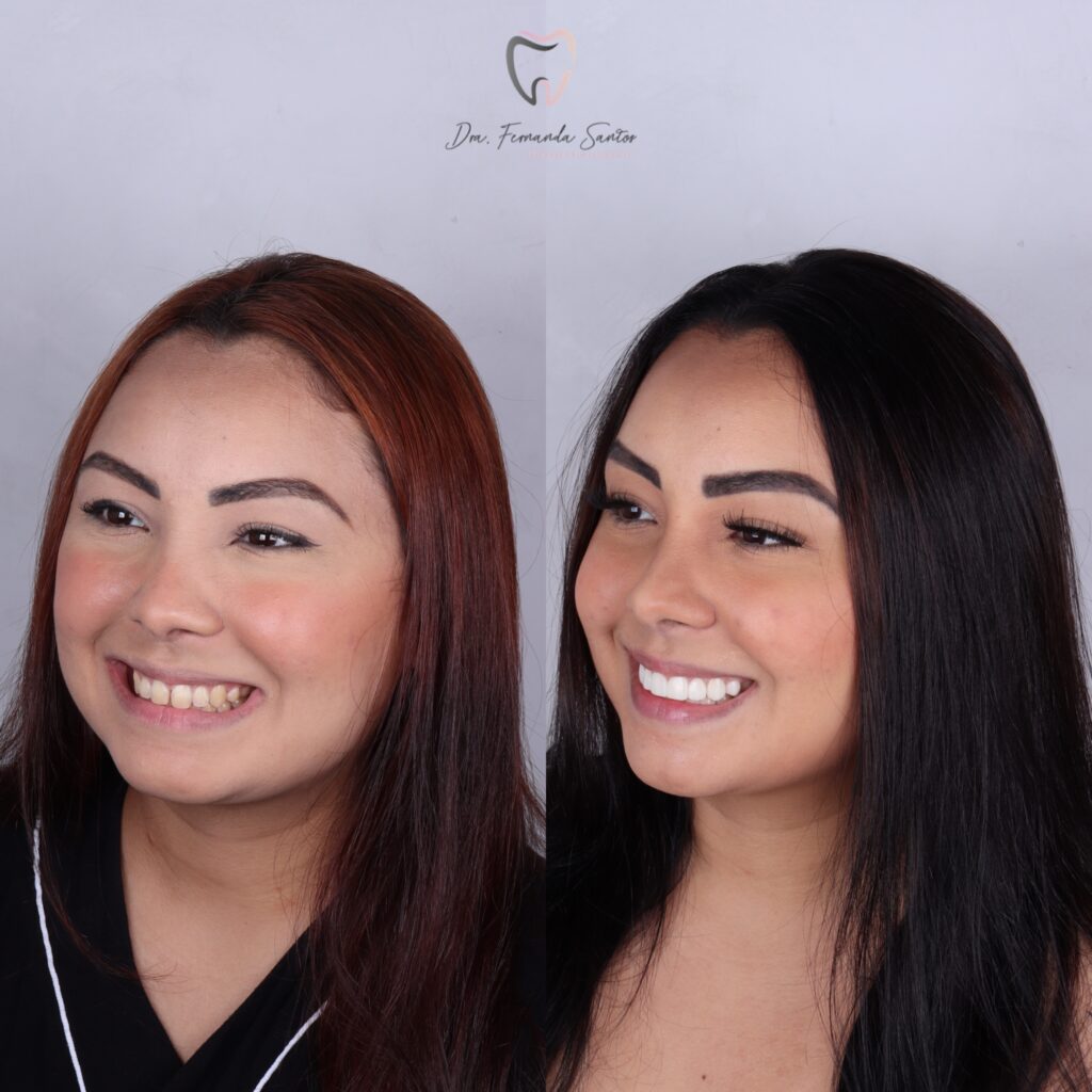 Facetas em Resina 20 Facetas em Resina Fortaleza