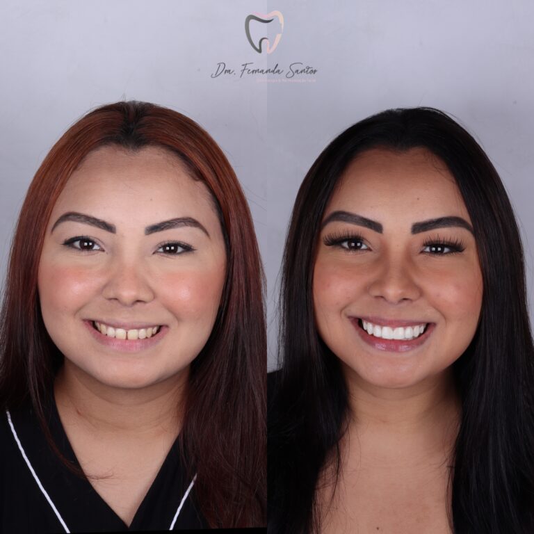 Facetas em Resina 22 Dr Igor Ribeiro — Dentiste CRO-CE 9062 Clinique IBR Fortaleza