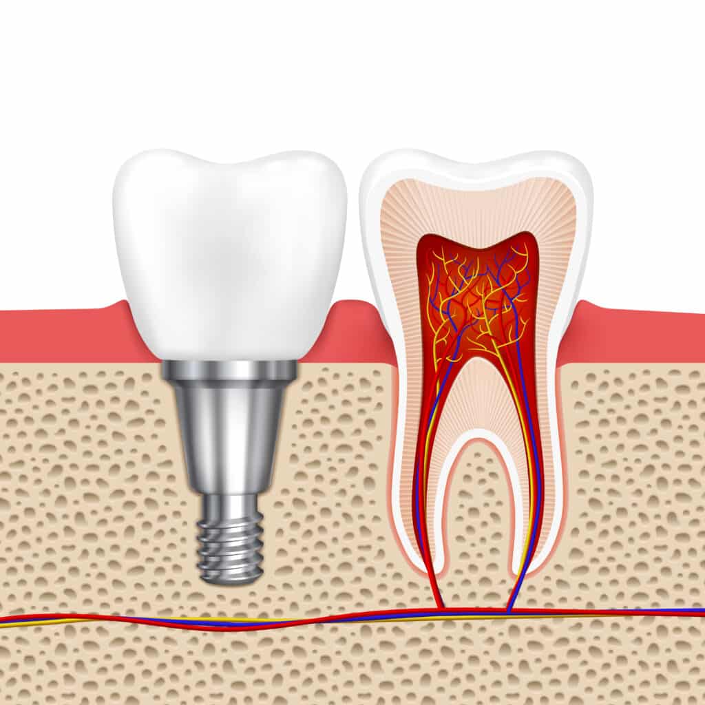 Implante dentário em Fortaleza — IBR Clinic | Dr. Igor Ribeiro