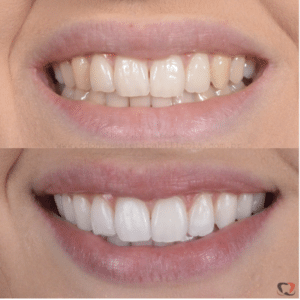 Scopri di più sull'articolo Saiba como atingir um sorriso mais branco com o Clareamento Dental em Fortaleza