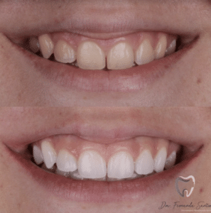 Clareamento de dentes em Fortaleza