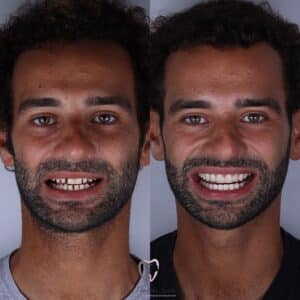 Resin Veneers in Fortaleza Dr. Fernanda Santos IBR Clinic
