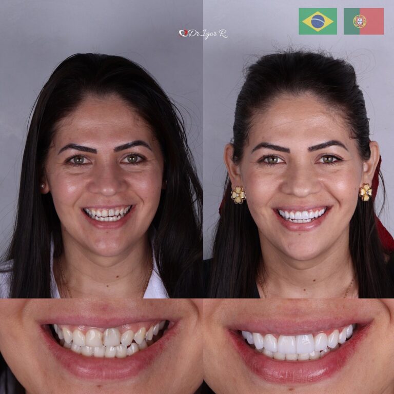 Home 18 Lentes de Contato Dental em Fortaleza