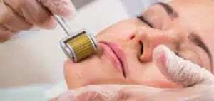 Lire la suite à propos de l’article Microagulhamento: um tratamento eficaz para a sua pele | Clínica de Estética em Fortaleza