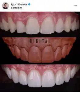 DENTAL CONTACT LENSES BEFORE AND AFTER