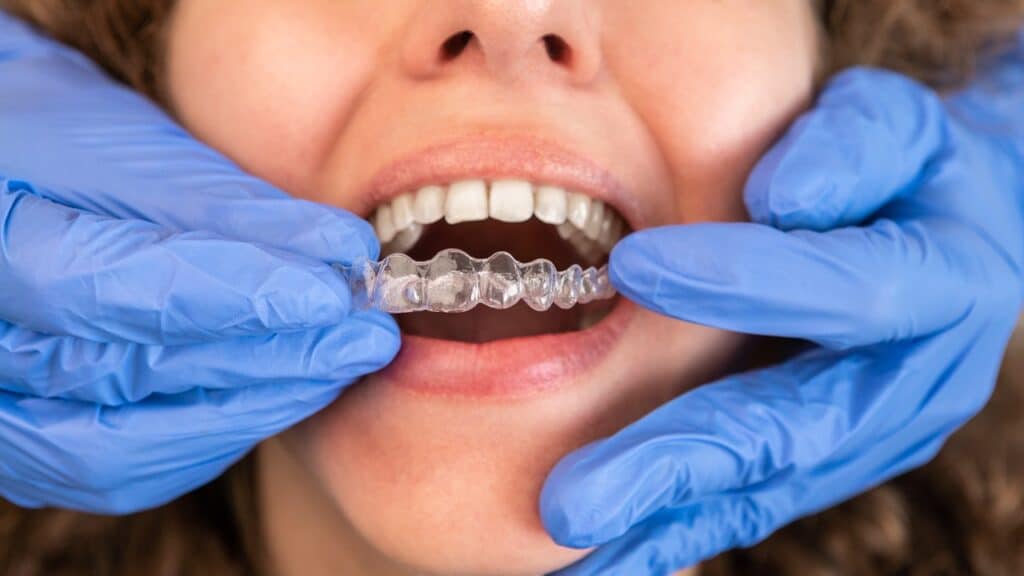 Invisalign en Fortaleza 2 Invisalign em Fortaleza — IBR Clinic | Dr. Igor Ribeiro