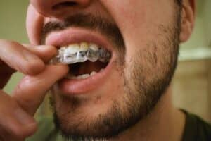 Invisalign em Fortaleza