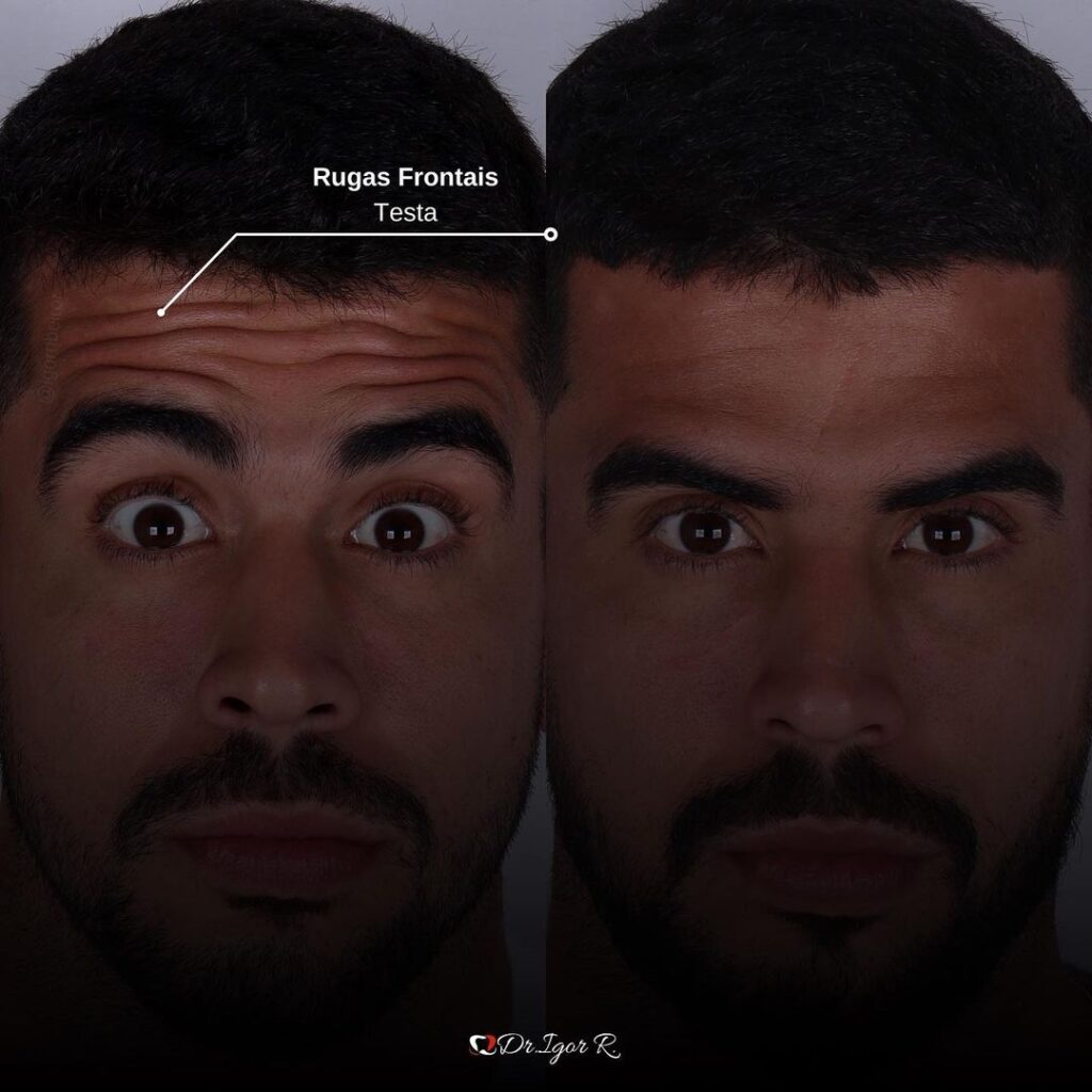 Botox em Fortaleza Rugas na ao redor dos olhos, Remoção de Rugass